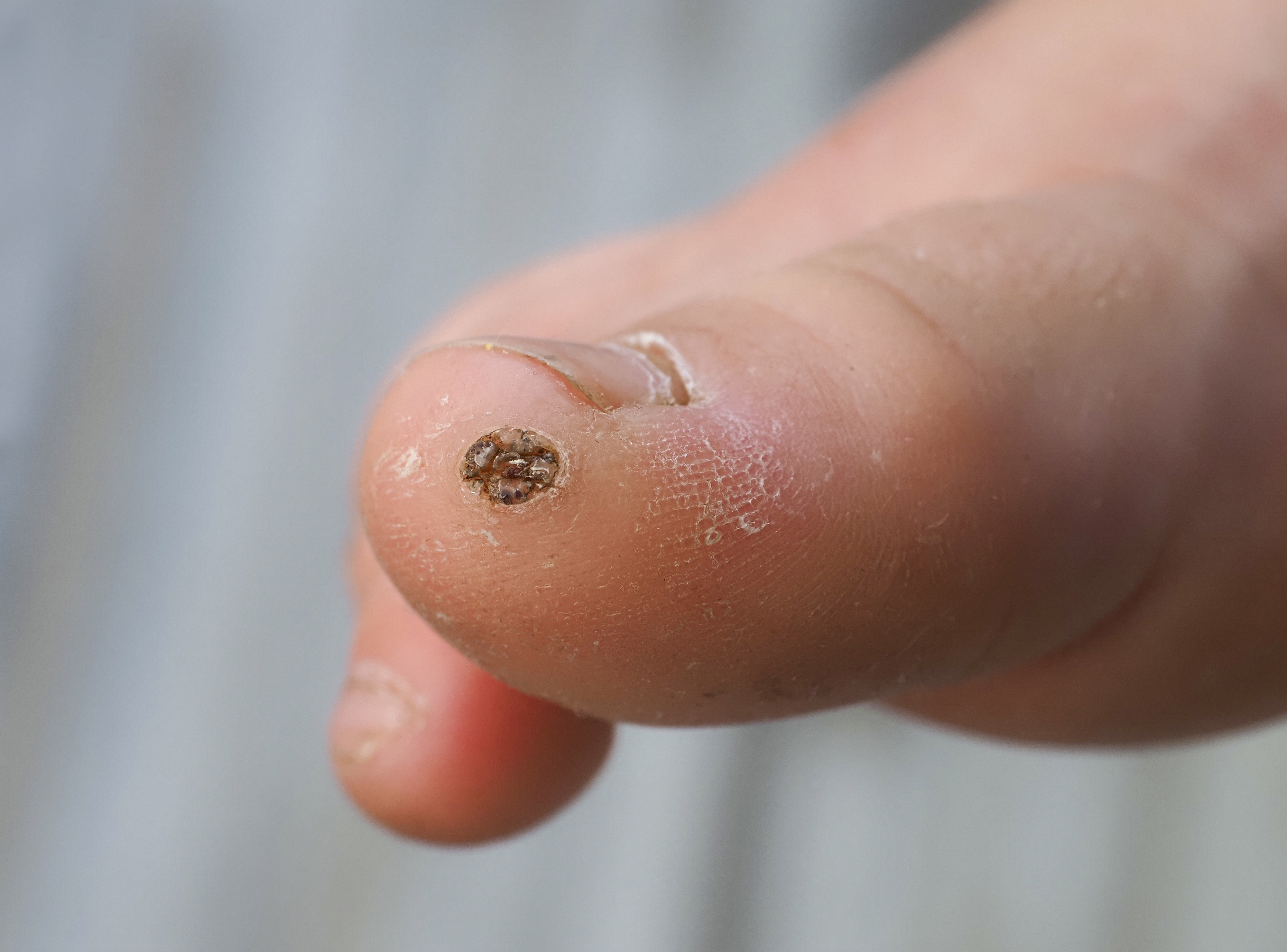 En LUR te ofrecemos una solución definitiva para la uña encarnada, nuestra cirgía ungueal es de rápida recuperación