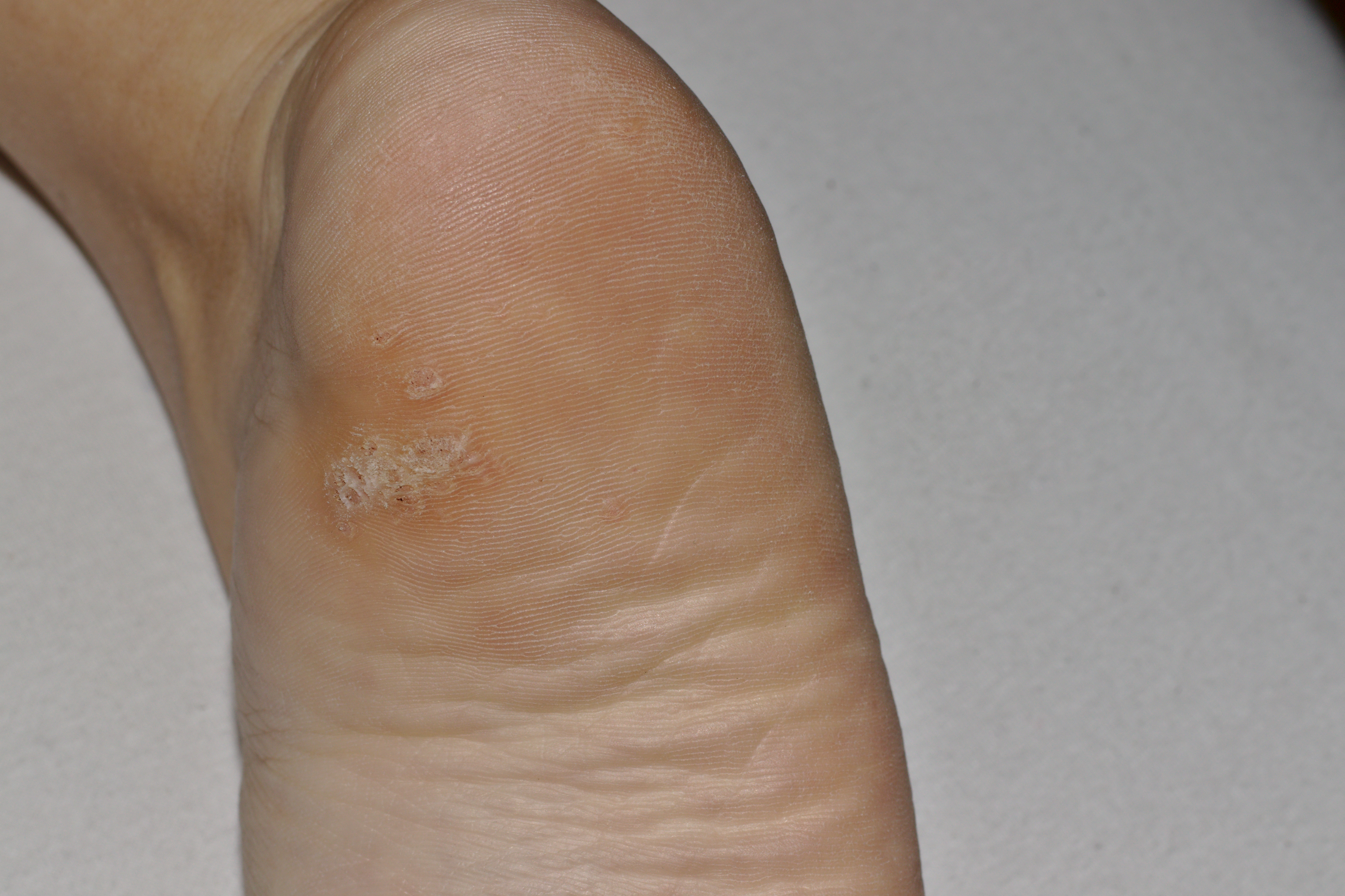 Soluciones para el papiloma o verruga plantar en Donostia